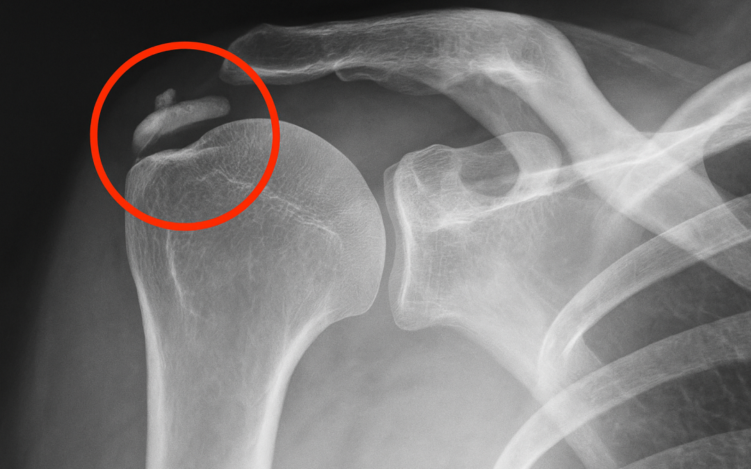 Litoclasia ecoguidata delle calcificazioni di spalla