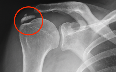 Litoclasia ecoguidata delle calcificazioni di spalla