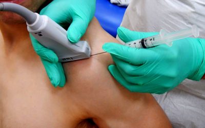 Borsite Sub-Acromiale: sintomi, diagnosi e trattamento con terapia infiltrativa