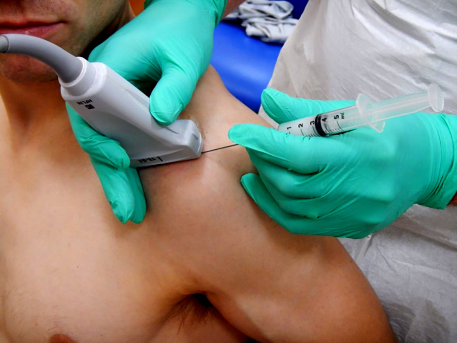 Borsite Sub-Acromiale: sintomi, diagnosi e trattamento con terapia infiltrativa