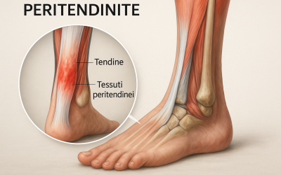 Peritendinite: diagnisi e terapia tramite idrodistensione ecoguidata