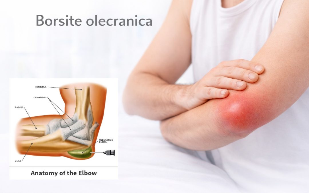 Borsite olecranica: cause, sintomi e quando intervenire