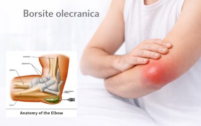 Borsite olecranica: cause, sintomi e quando intervenire