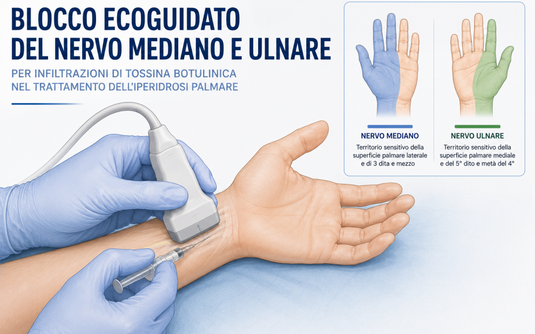 Blocco ecoguidato del nervo mediano e del nervo ulnare per il trattamento dell’iperidrosi palmare mediante tossina botulinica
